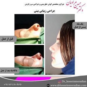 جراحی بینی شیراز