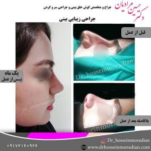 جراحی بینی در شیراز