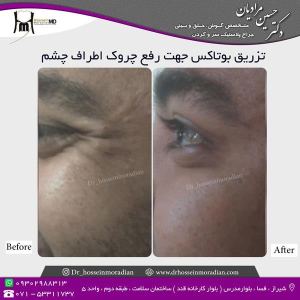 تزریق-بوتاکس-1