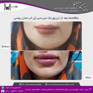 تزریق-ژل-لب-1