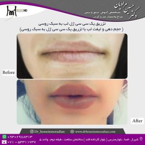 تزریق-ژل-لب-2