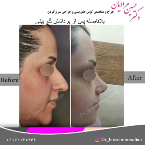 جراحی بینی شیراز 1