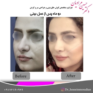جراحی بینی شیراز 10