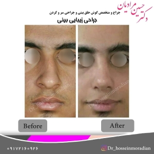 جراحی بینی شیراز 12