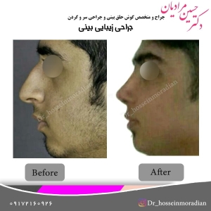 جراحی بینی شیراز 13