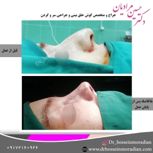 جراحی بینی شیراز 14