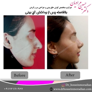 جراحی بینی شیراز 15