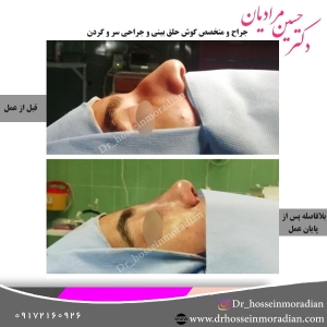 جراحی بینی شیراز 16
