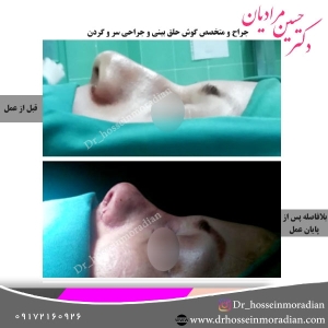 جراحی-بینی-شیراز-18