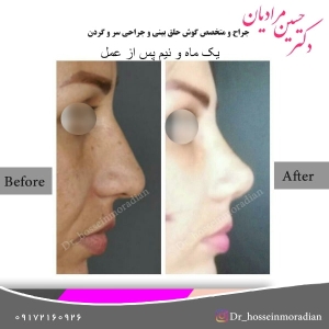 جراحی بینی شیراز 2