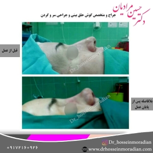 جراحی-بینی-شیراز-20