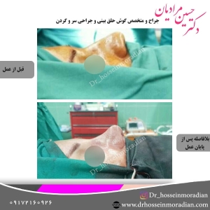 جراحی-بینی-شیراز-23