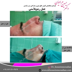 جراحی-بینی-شیراز-25