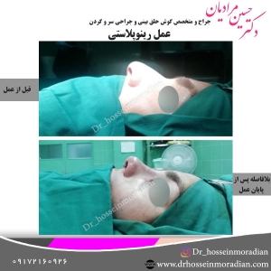 جراحی-بینی-شیراز-27