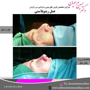 جراحی-بینی-شیراز-29