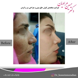 جراحی بینی شیراز 3