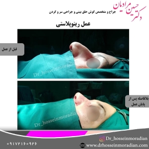 جراحی-بینی-شیراز-32