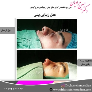 جراحی-بینی-شیراز-33