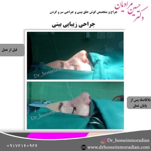 جراحی-بینی-شیراز-34