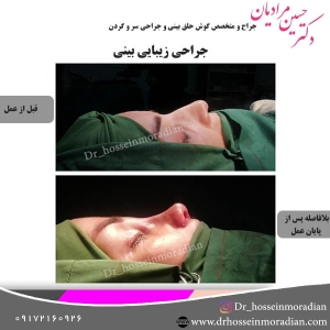 جراحی-بینی-شیراز-36