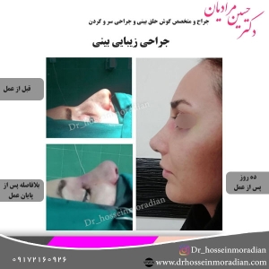جراحی-بینی-شیراز-37