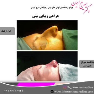 جراحی-بینی-شیراز-38