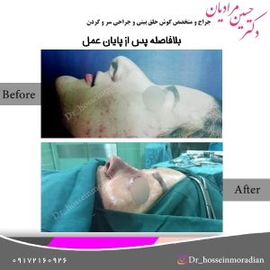 جراحی بینی شیراز 4