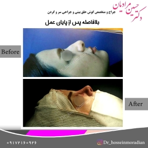 جراحی بینی شیراز 5
