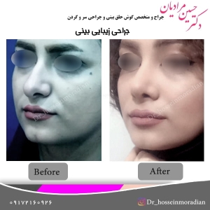جراحی بینی شیراز 6