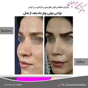 جراحی بینی شیراز 8
