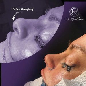 جراحی-بینی-81