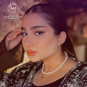 rhinoplasty-155