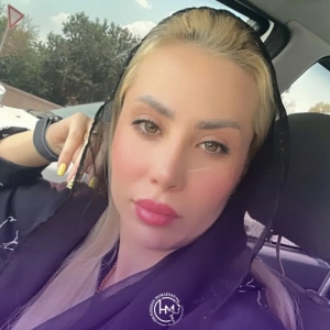 rhinoplasty-158