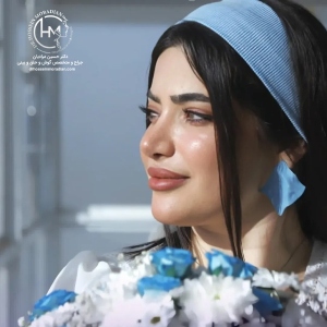 rhinoplasty-169