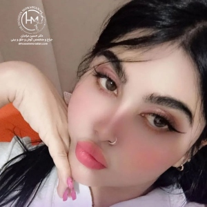 rhinoplasty-176
