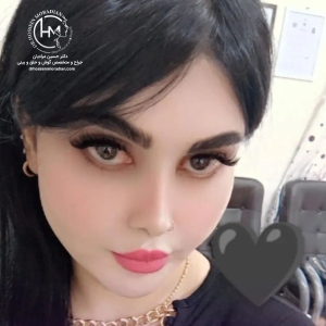 rhinoplasty-177