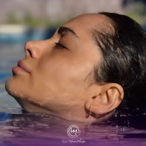 rhinoplasty-179