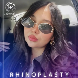 rhinoplasty-192