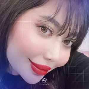 rhinoplasty-208
