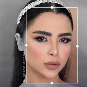 rhinoplasty-210