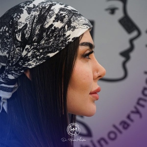rhinoplasty-213