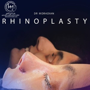 rhinoplasty-220