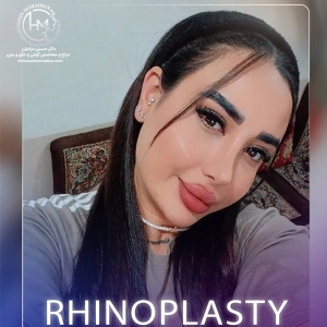 rhinoplasty-221