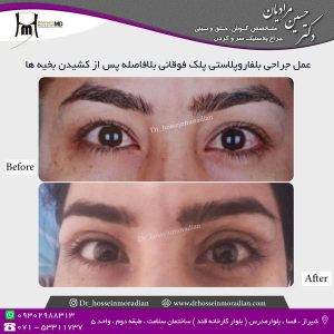 جراحی-پلک-1