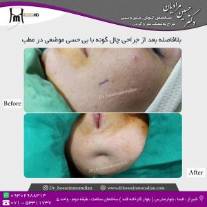 جراحی-چال-گونه-1