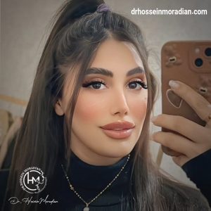 جراحی بینی ترمیمی در شیراز - دکتر حسین مرادیان 