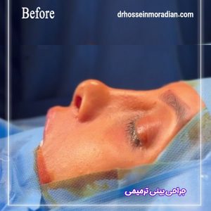 قبل از جراحی بینی ترمیمی - دکتر حسین مرادیان 
