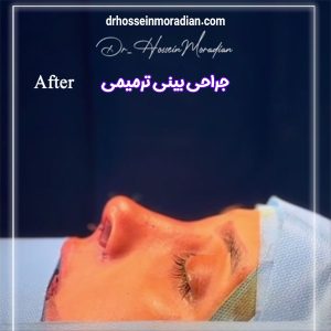 بعد از جراحی بینی ترمیمی - دکتر حسین مرادیان 