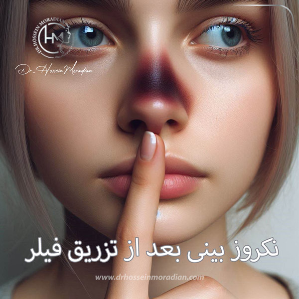 نکروز بینی بعد از تزریق فیلر - دکتر حسین مرادیان