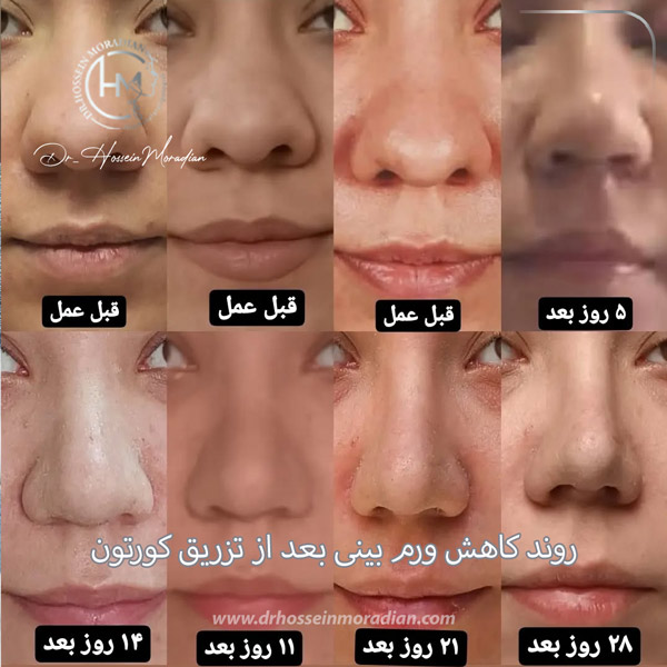 تزریق کورتون به بینی بعد از عمل - دکتر مرادیان